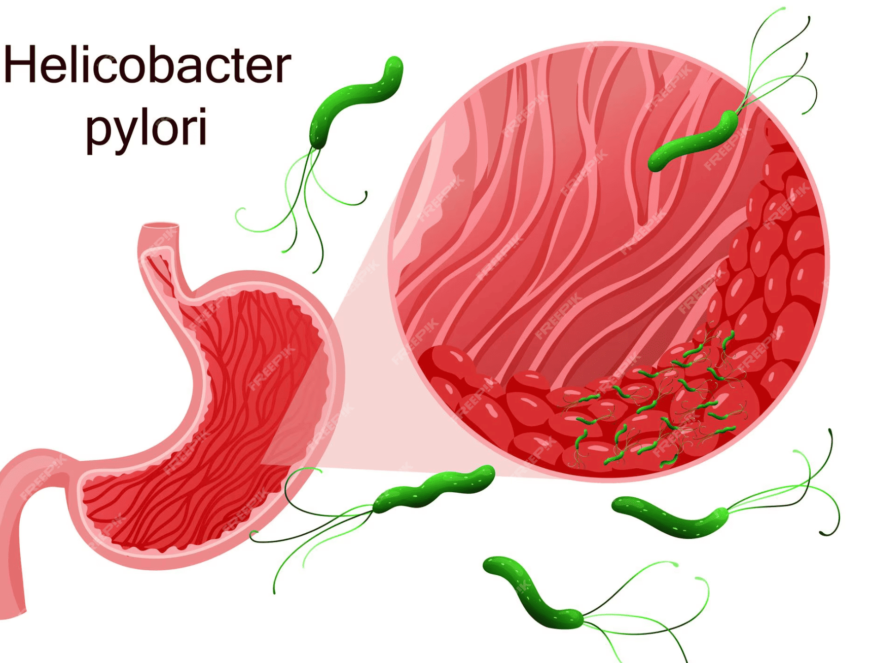 تحليل جرثومة المعدة بالنفخ وأهميته الصحية
